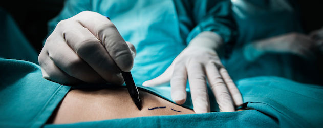 Putting Cosmetic Surgery on Your Plastic? Avoid These Complications